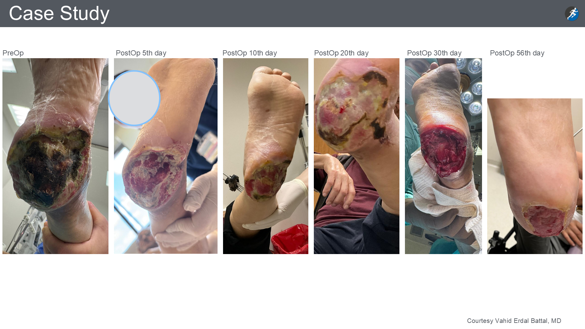Slide 19: six photographs of a heel wound, labelled before surgery and postoperative days 5, 10, 20, 30 and 56
