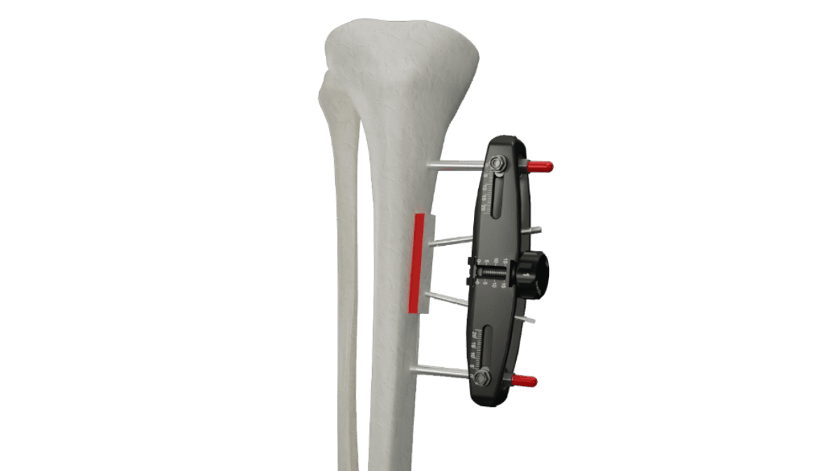 MicroLift external fixation device illustrated on a tibia bone model